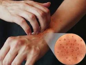 obat alami madu untuk gatal kulit yang wajib kita ketahui