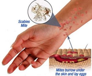 penyebab gatal dan khasiat madu untuk gatal kulit