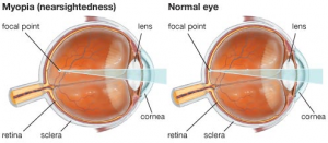 manfaat madu untuk mata rabun
